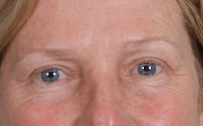 Blepharoplasty Before & After Gallery - Patient 210692 - Image 2