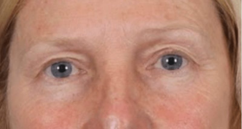 Blepharoplasty Before & After Gallery - Patient 210692 - Image 1