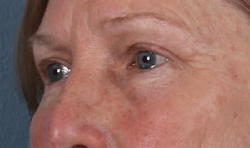 Blepharoplasty Before & After Gallery - Patient 210692 - Image 4