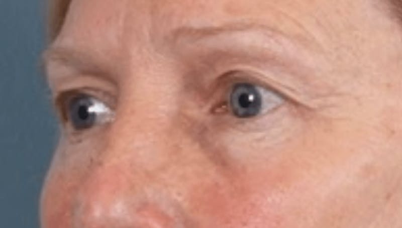 Blepharoplasty Before & After Gallery - Patient 210692 - Image 3