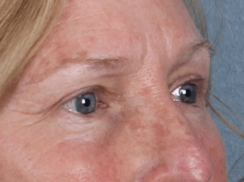 Blepharoplasty Before & After Gallery - Patient 210692 - Image 6
