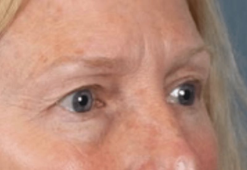 Blepharoplasty Before & After Gallery - Patient 210692 - Image 5