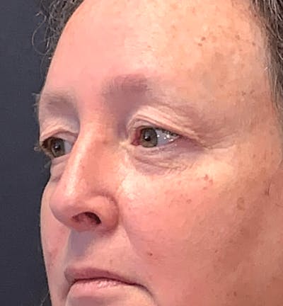 Blepharoplasty Before & After Gallery - Patient 344403 - Image 1