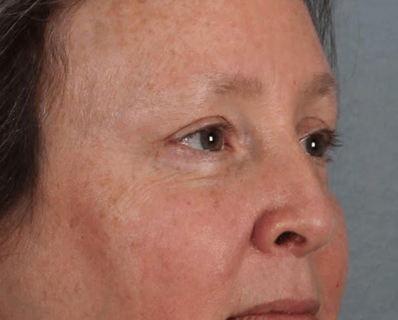 Blepharoplasty Before & After Gallery - Patient 344403 - Image 4