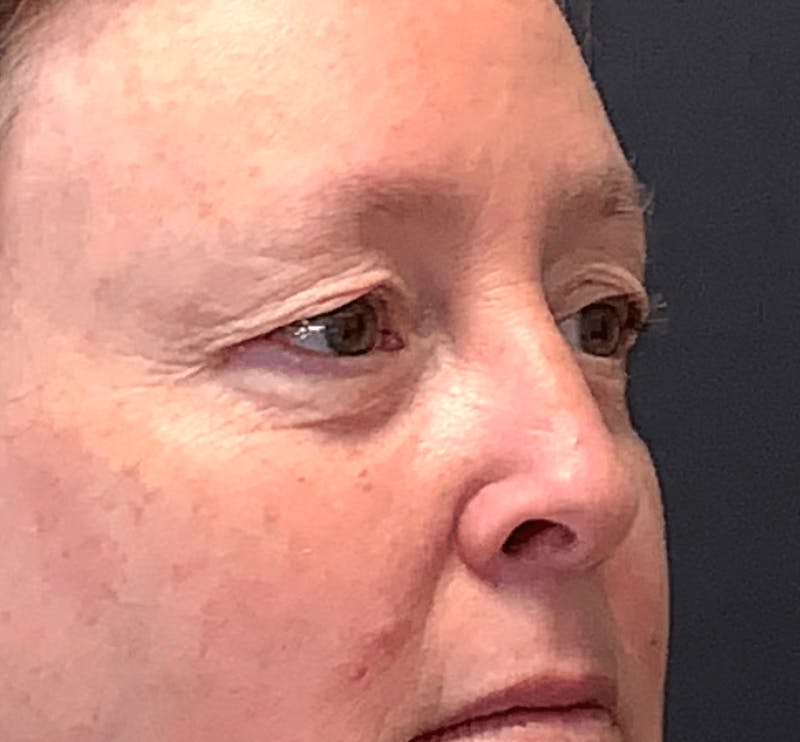 Blepharoplasty Before & After Gallery - Patient 344403 - Image 3