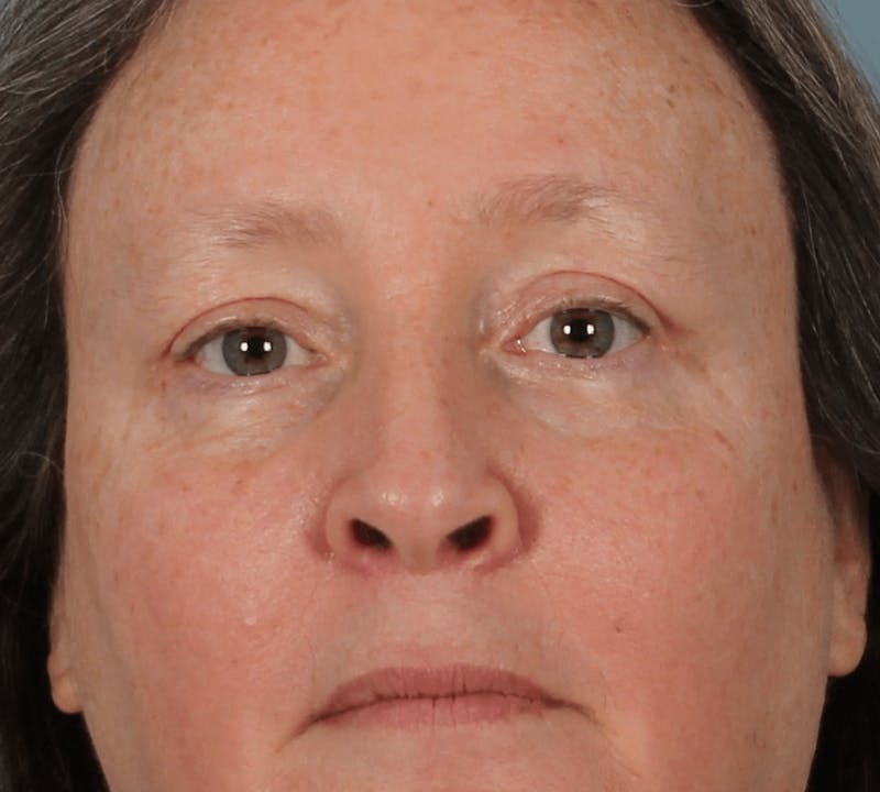 Blepharoplasty Before & After Gallery - Patient 344403 - Image 6