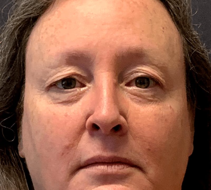 Blepharoplasty Before & After Gallery - Patient 344403 - Image 5