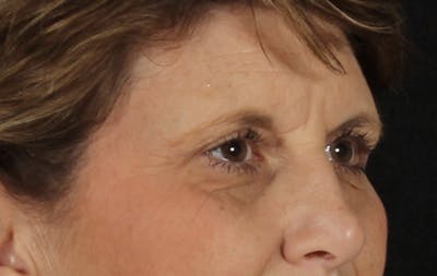 Blepharoplasty Before & After Gallery - Patient 731075 - Image 2