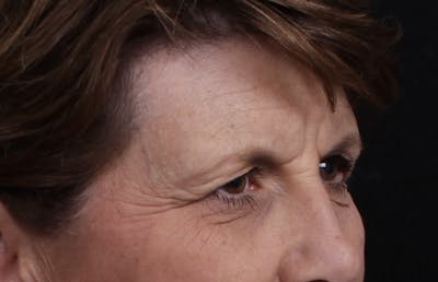 Blepharoplasty Before & After Gallery - Patient 731075 - Image 1