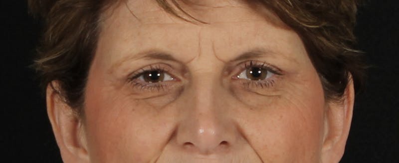 Blepharoplasty Before & After Gallery - Patient 731075 - Image 4