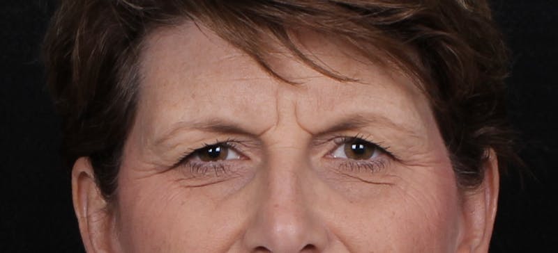 Blepharoplasty Before & After Gallery - Patient 731075 - Image 3