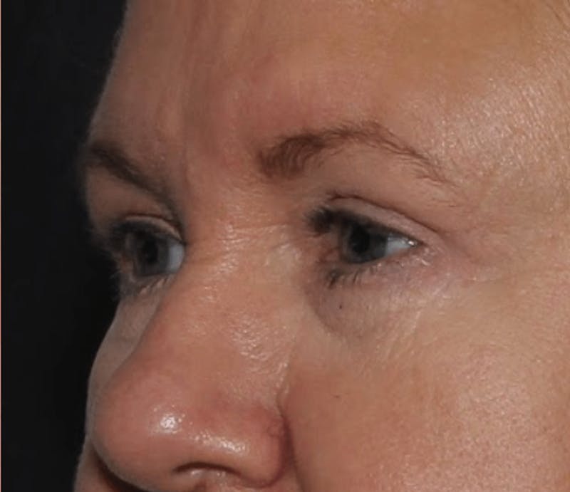 Blepharoplasty Before & After Gallery - Patient 144139 - Image 4