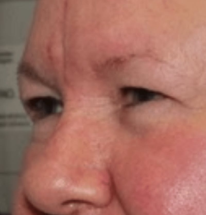 Blepharoplasty Before & After Gallery - Patient 144139 - Image 3