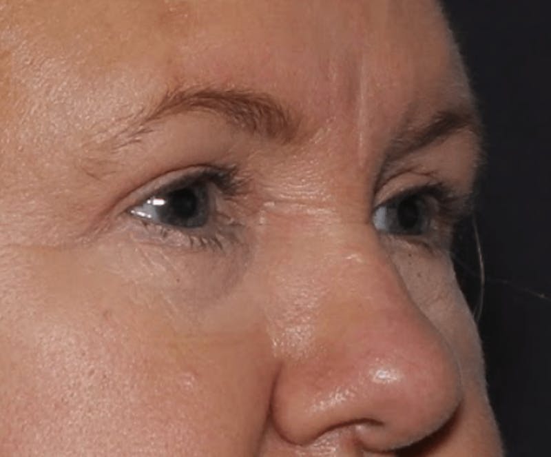 Blepharoplasty Before & After Gallery - Patient 144139 - Image 6
