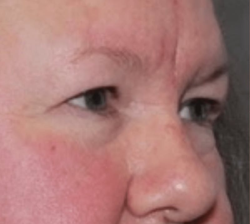 Blepharoplasty Before & After Gallery - Patient 144139 - Image 5