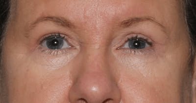 Blepharoplasty Before & After Gallery - Patient 144139 - Image 2