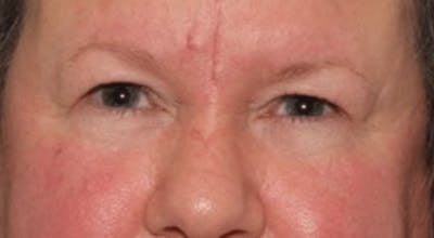 Blepharoplasty Before & After Gallery - Patient 144139 - Image 1