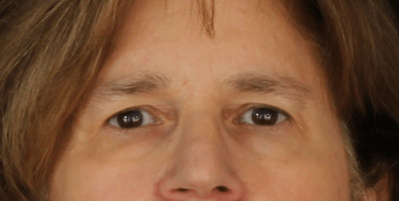 Blepharoplasty Before & After Gallery - Patient 624087 - Image 1