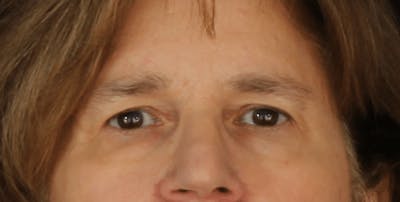 Blepharoplasty Before & After Gallery - Patient 624087 - Image 1