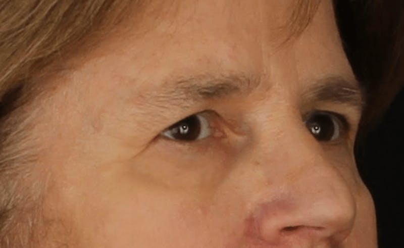 Blepharoplasty Before & After Gallery - Patient 624087 - Image 3