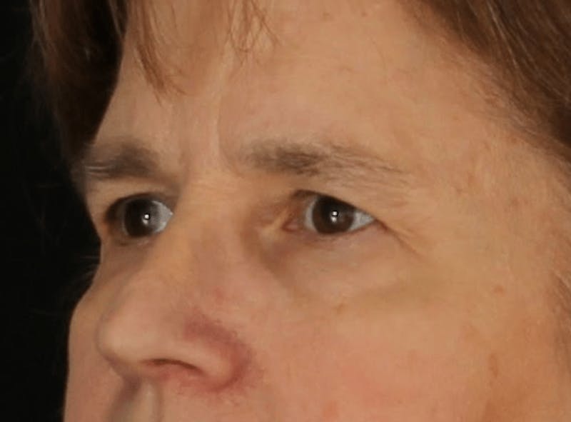 Blepharoplasty Before & After Gallery - Patient 624087 - Image 5