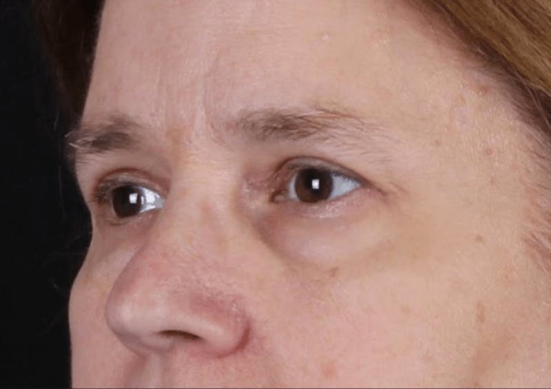 Blepharoplasty Before & After Gallery - Patient 624087 - Image 6