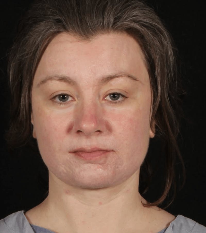 Face & Neck Lift Before & After Gallery - Patient 373301 - Image 4