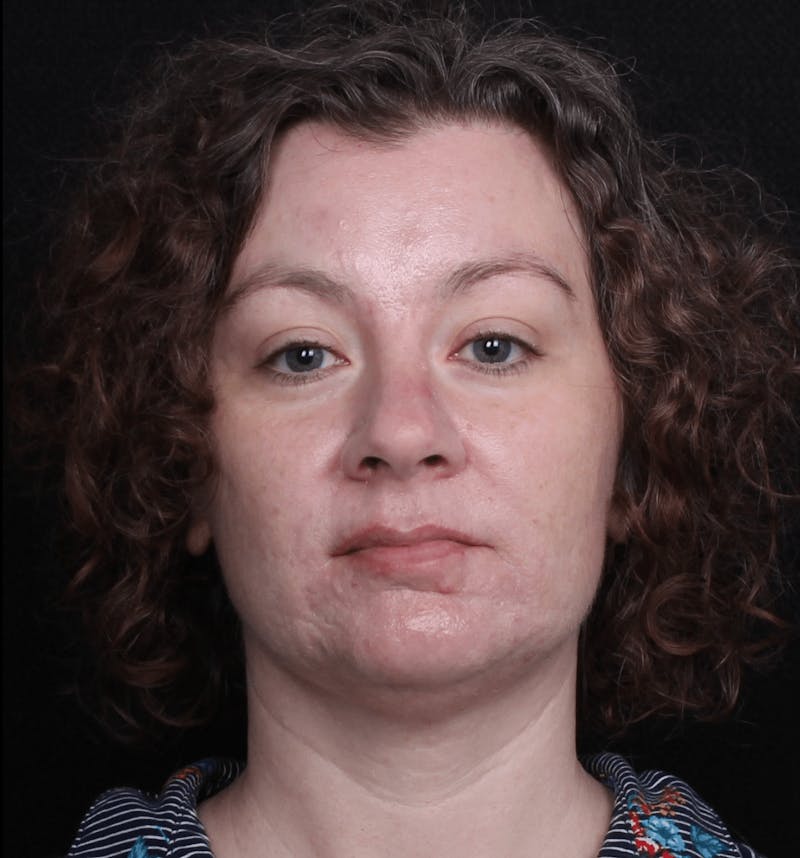 Face & Neck Lift Before & After Gallery - Patient 373301 - Image 3