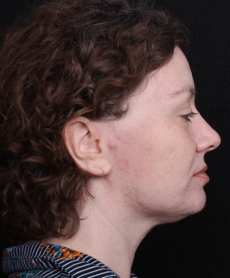 Face & Neck Lift Before & After Gallery - Patient 373301 - Image 5