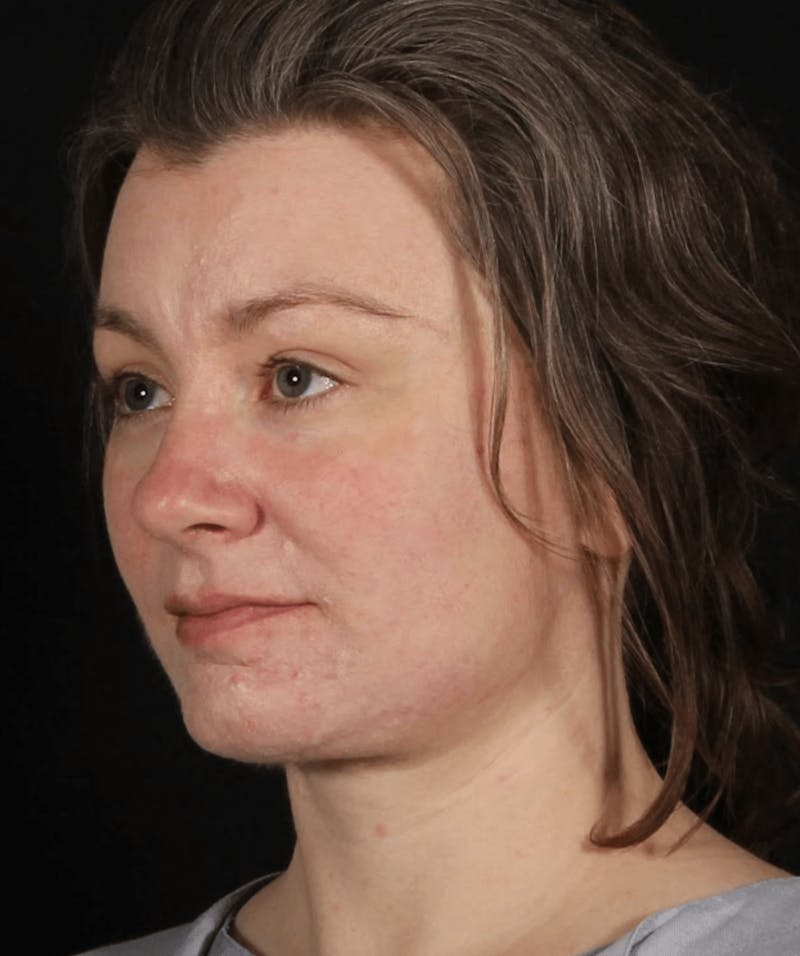 Face & Neck Lift Before & After Gallery - Patient 373301 - Image 8