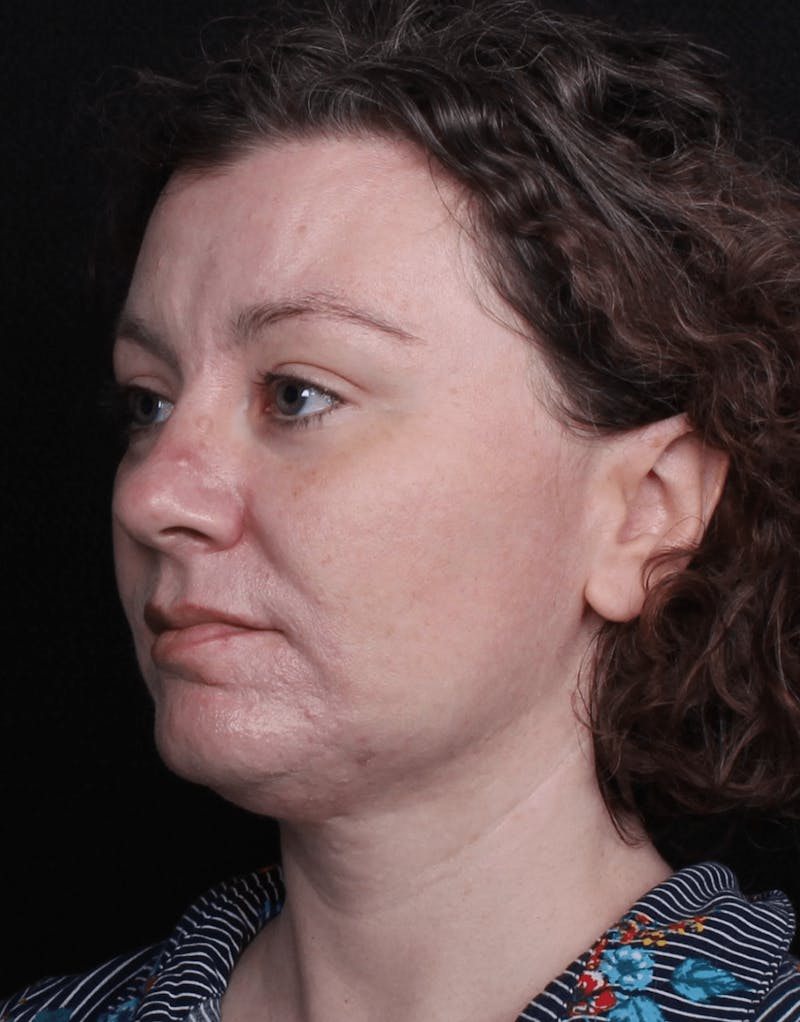 Face & Neck Lift Before & After Gallery - Patient 373301 - Image 7