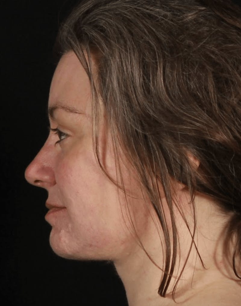 Face & Neck Lift Before & After Gallery - Patient 373301 - Image 10