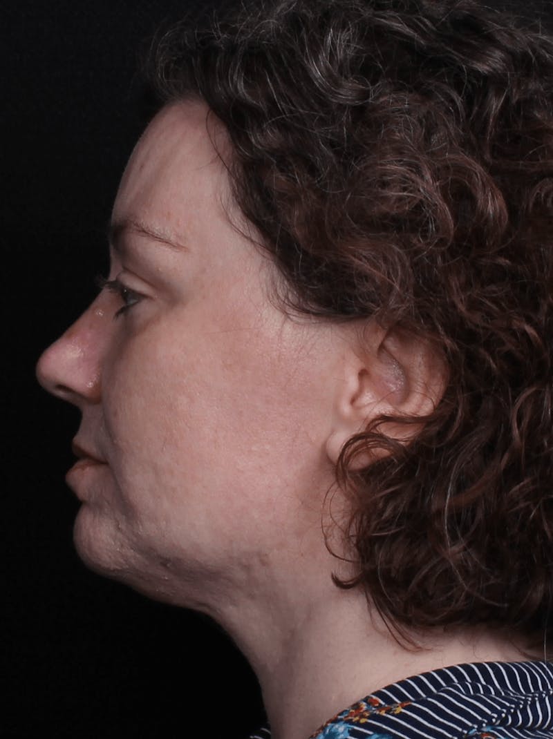 Face & Neck Lift Before & After Gallery - Patient 373301 - Image 9