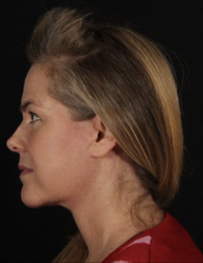 Face & Neck Lift Before & After Gallery - Patient 278418 - Image 2
