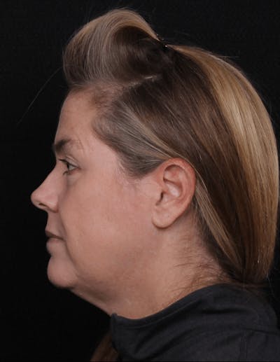 Face & Neck Lift Before & After Gallery - Patient 278418 - Image 1
