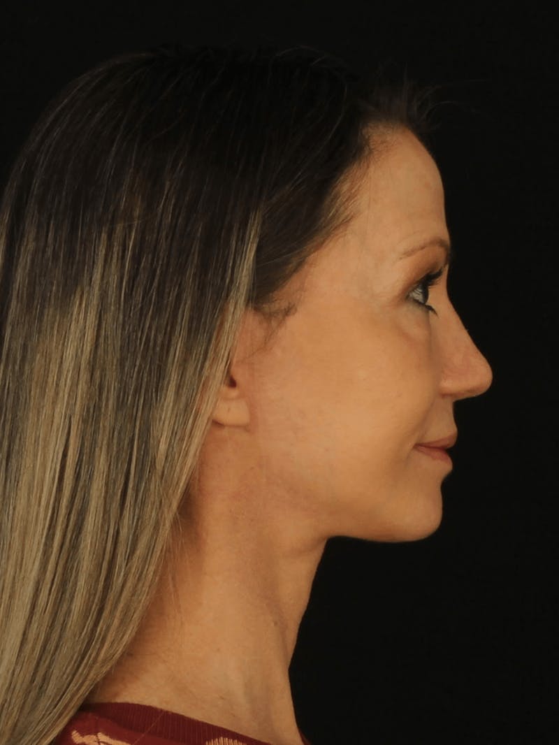 Face & Neck Lift Before & After Gallery - Patient 307182 - Image 4
