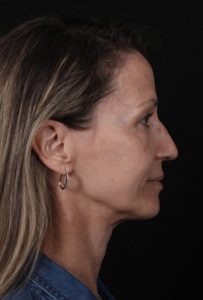 Face & Neck Lift Before & After Gallery - Patient 307182 - Image 3