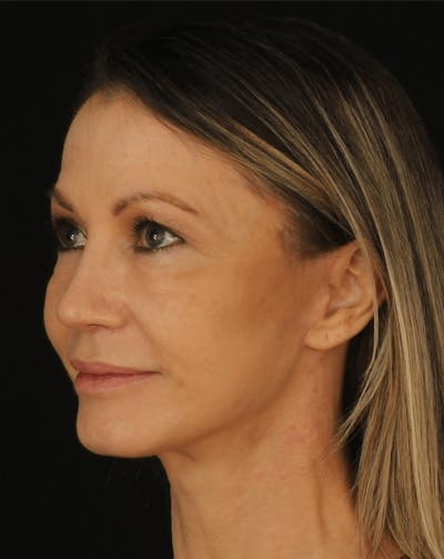 Face & Neck Lift Before & After Gallery - Patient 307182 - Image 2