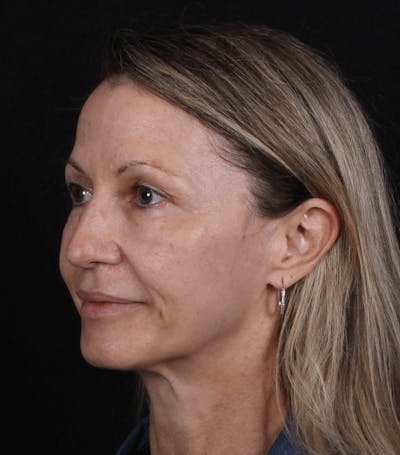 Face & Neck Lift Before & After Gallery - Patient 307182 - Image 1