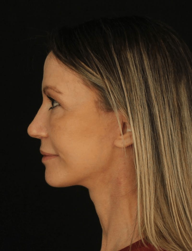 Face & Neck Lift Before & After Gallery - Patient 307182 - Image 6