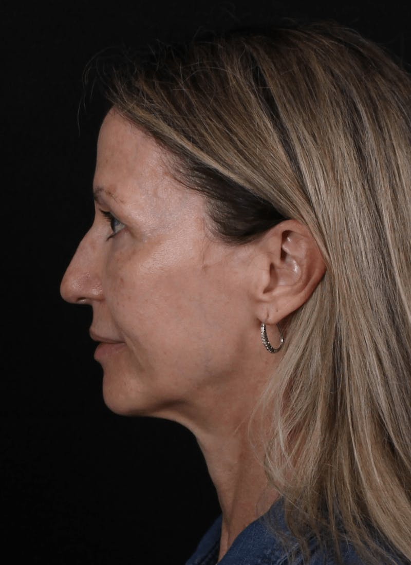 Face & Neck Lift Before & After Gallery - Patient 307182 - Image 5