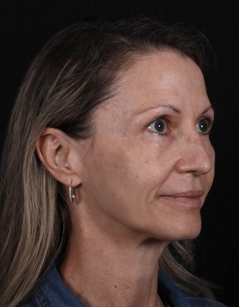 Face & Neck Lift Before & After Gallery - Patient 307182 - Image 7