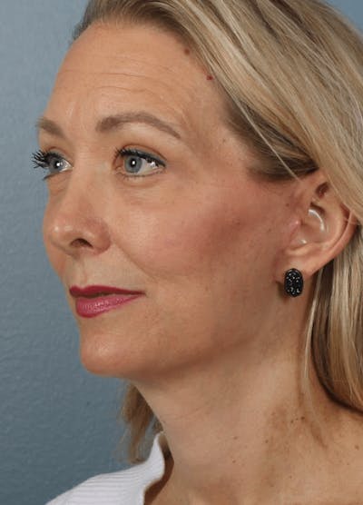 Face & Neck Lift Before & After Gallery - Patient 190589 - Image 2