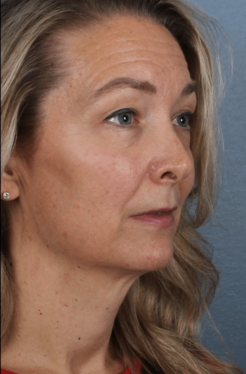 Face & Neck Lift Before & After Gallery - Patient 190589 - Image 3
