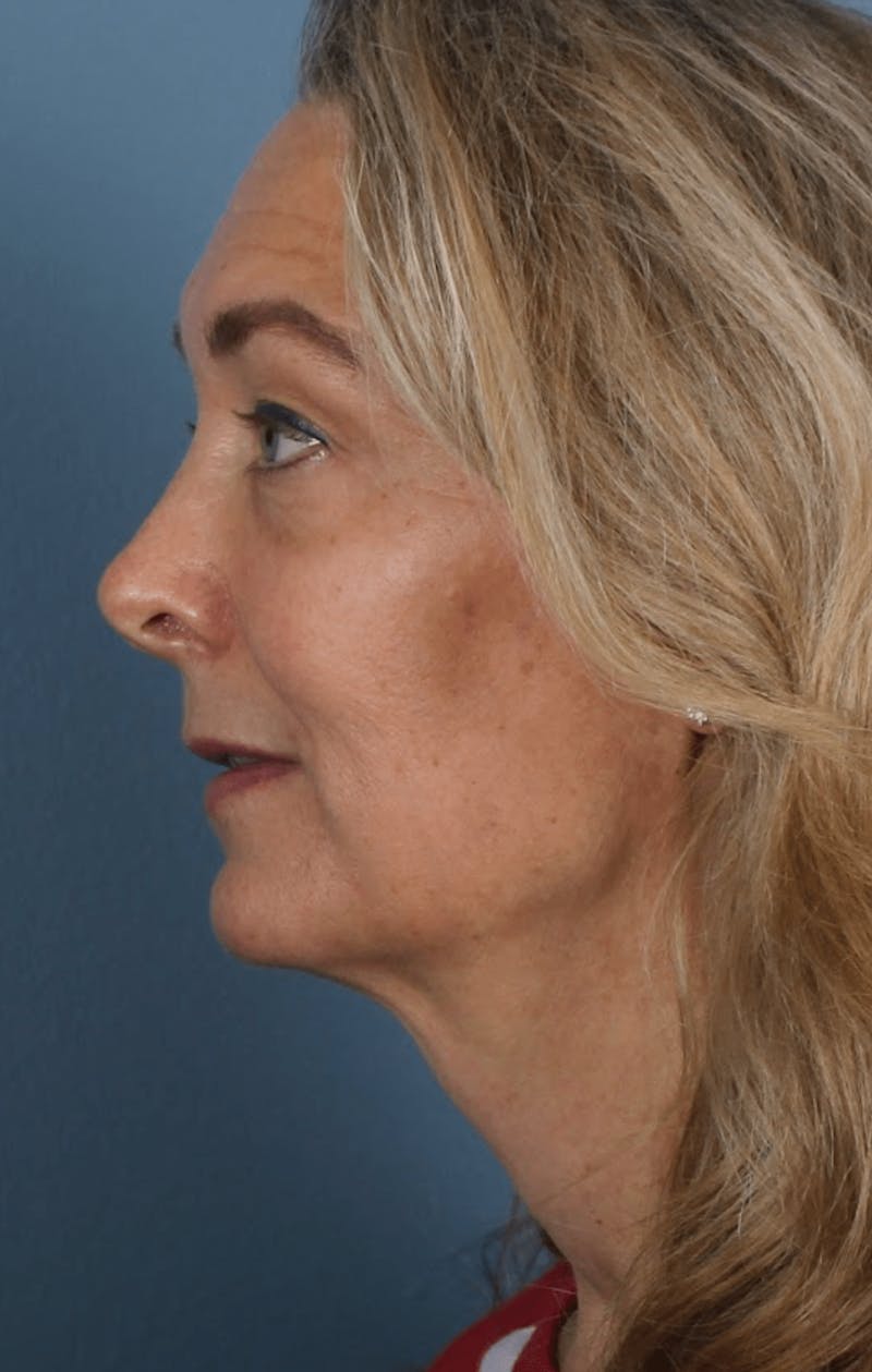 Face & Neck Lift Before & After Gallery - Patient 190589 - Image 7