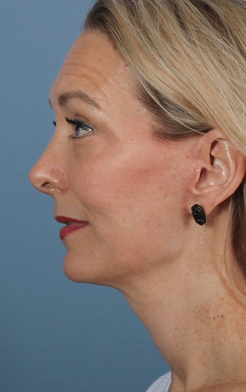 Face & Neck Lift Before & After Gallery - Patient 190589 - Image 8