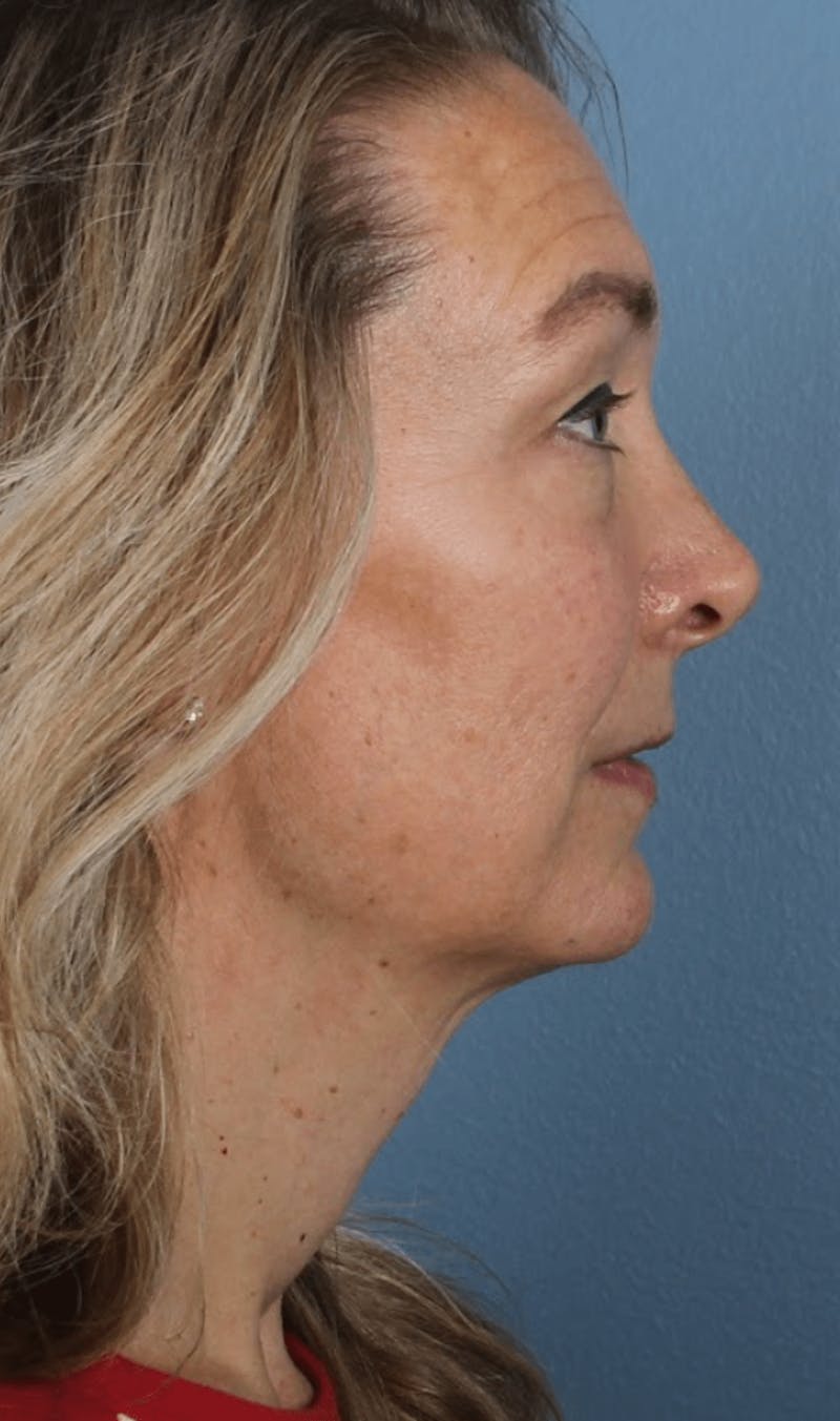 Face & Neck Lift Before & After Gallery - Patient 190589 - Image 9