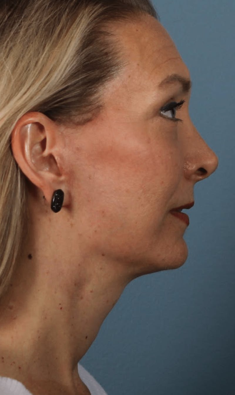 Face & Neck Lift Before & After Gallery - Patient 190589 - Image 10