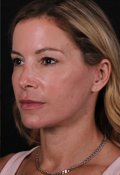 Face & Neck Lift Before & After Gallery - Patient 337411 - Image 2