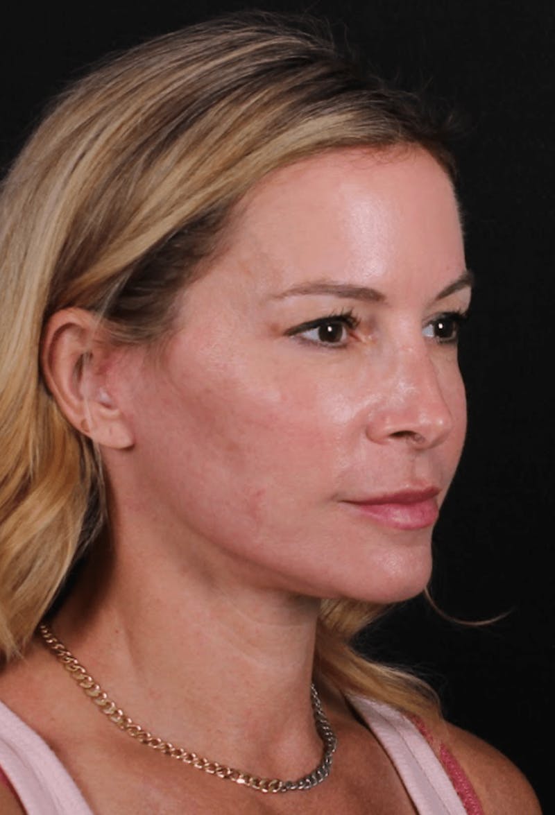 Face & Neck Lift Before & After Gallery - Patient 337411 - Image 6